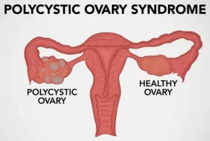 What a polycystic ovary looks like