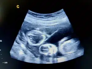 Ultrasound image